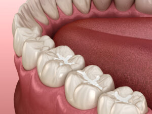 Molar Fissure dental sealants, 3D illustration