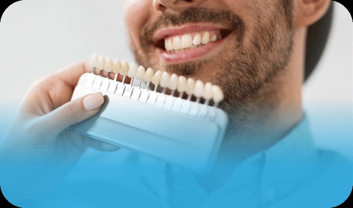 Close-up of dental patient smiling with teeth whitening color samples held in front of his teeth