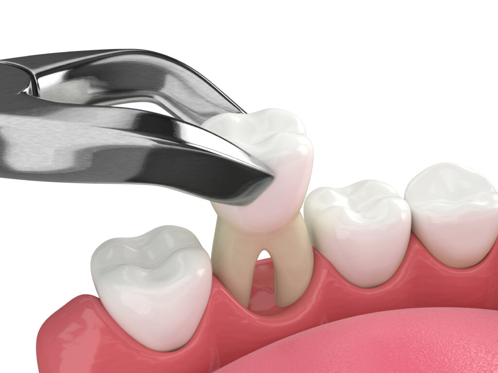 3d render of lower jaw with tooth being pulled out and extracted by dental forceps