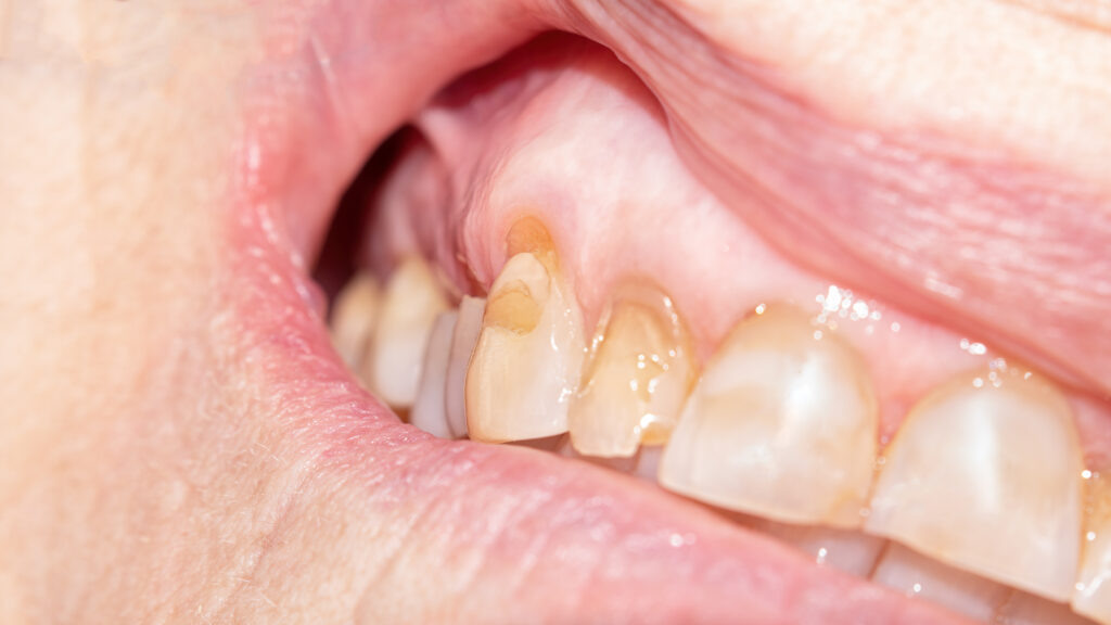 Primer plano de dientes con pérdida de esmalte y erosión.