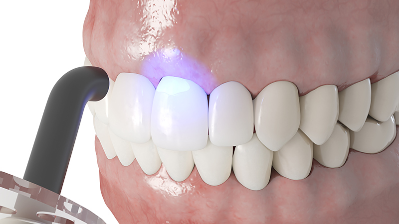 Dental bonding concept: Teeth being bonded with a UV light