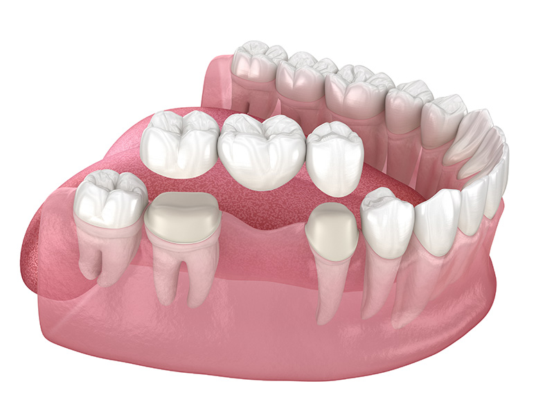 Dental Bridges