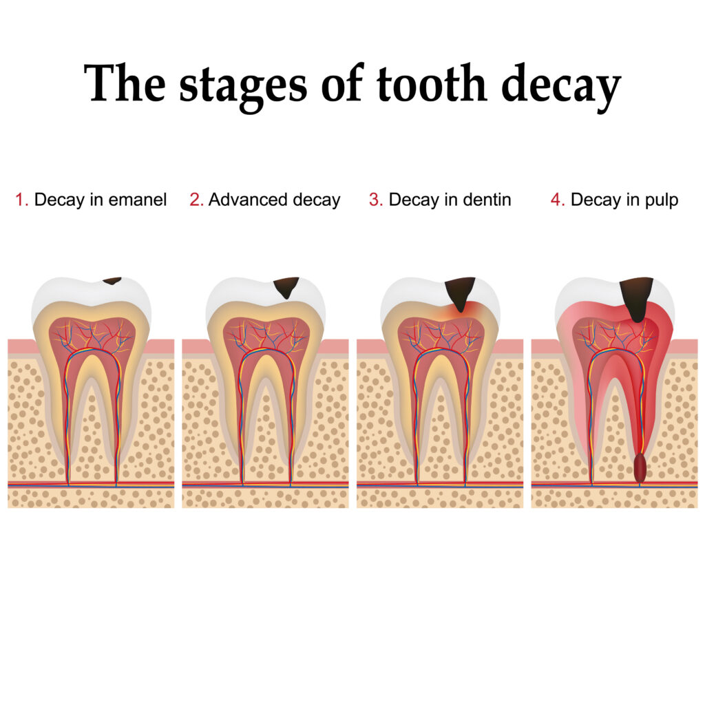 Imagen de la formación de la caries dental paso a paso, formando placa dental y finalmente caries y cavidad.