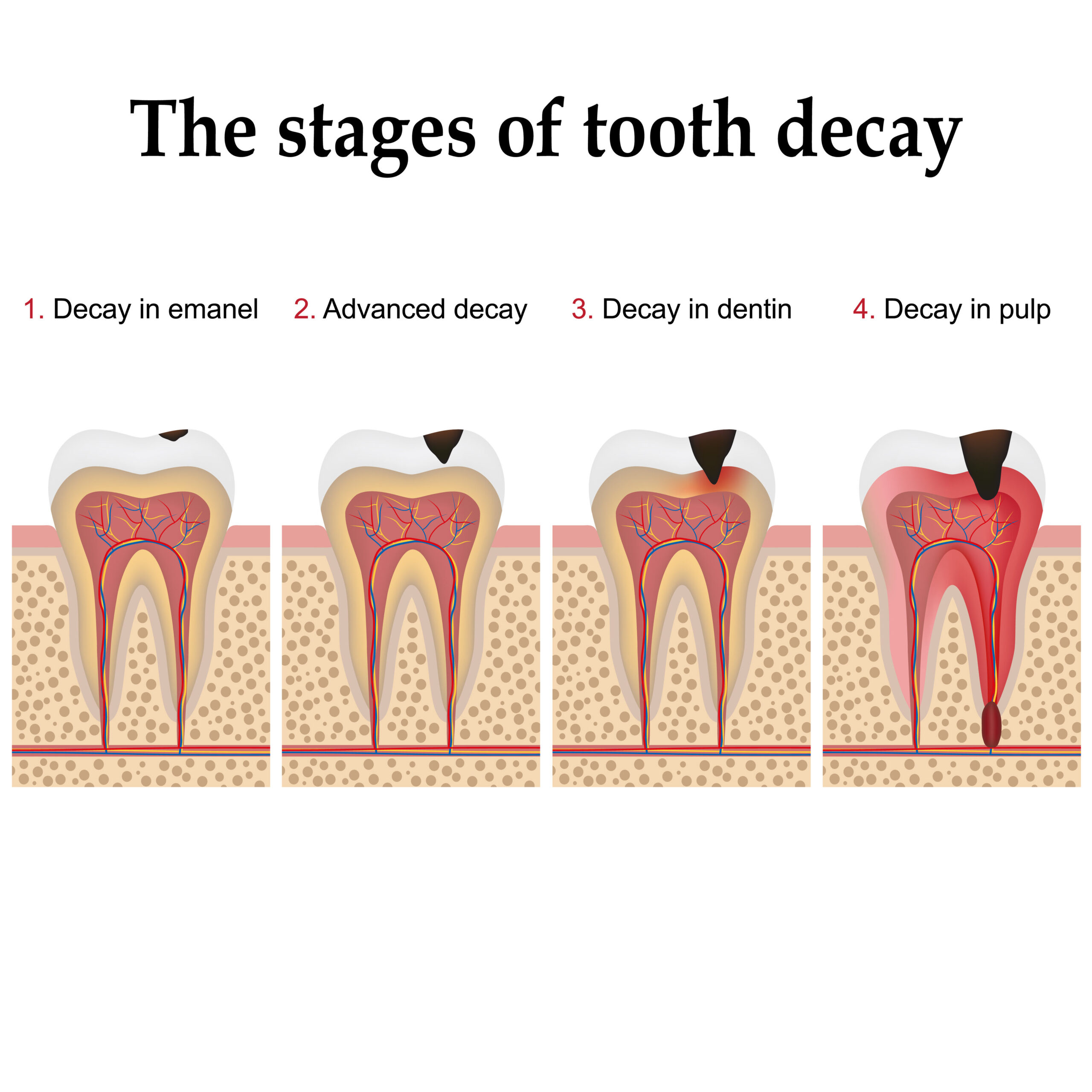 Imagen de la formación de la caries dental paso a paso, formando placa dental y finalmente caries y cavidad.