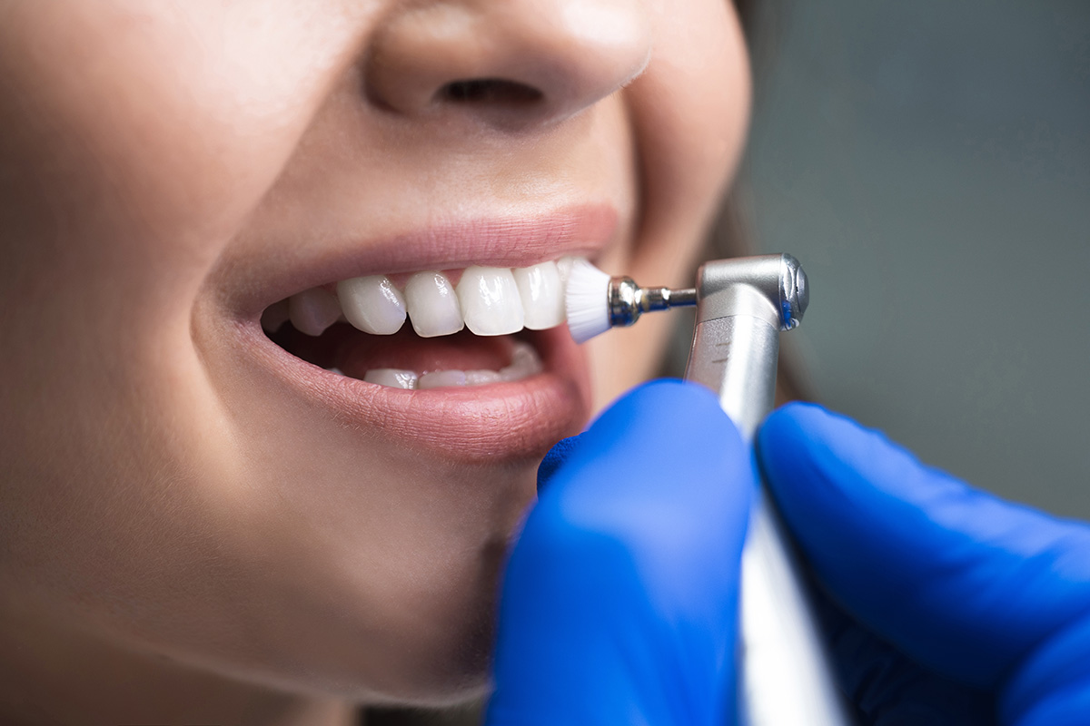 Hygienist using a stomatological brush on front teeth during dental cleaning procedure