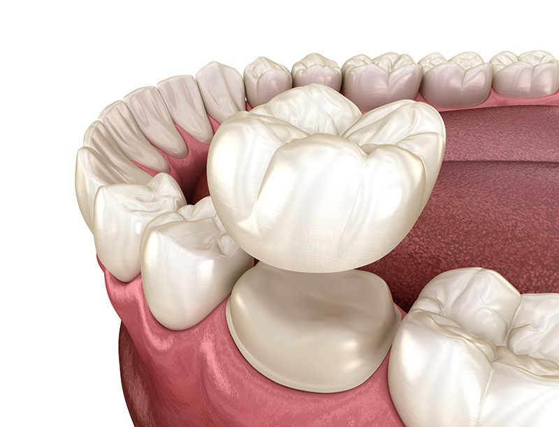 Rendering of dental crown and abutment