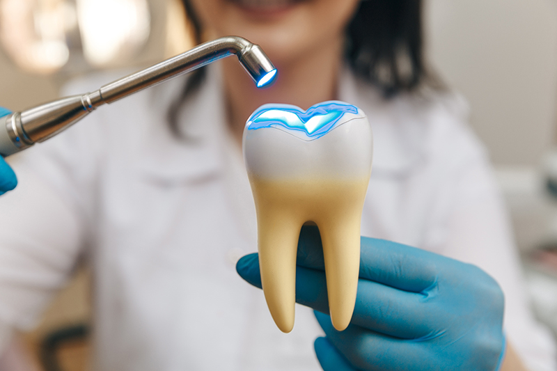 Dentist holding model of a tooth with a dental filling being cured by UV light