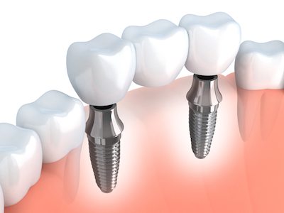 Dental implant bridge