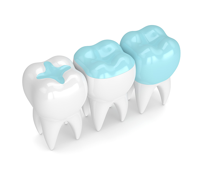 Dental Fillings, Inlays Onlays