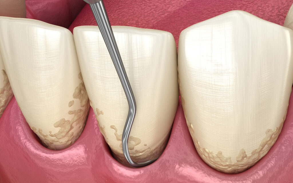 Ilustración 3D médicamente precisa que muestra el raspado y alisado radicular (terapia periodontal convencional).
