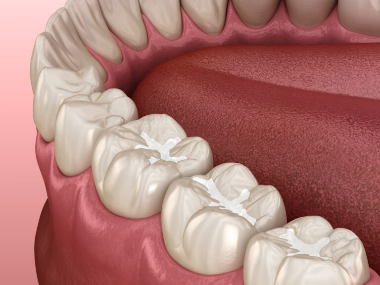 Rendering of dental sealants in the fissures of molars