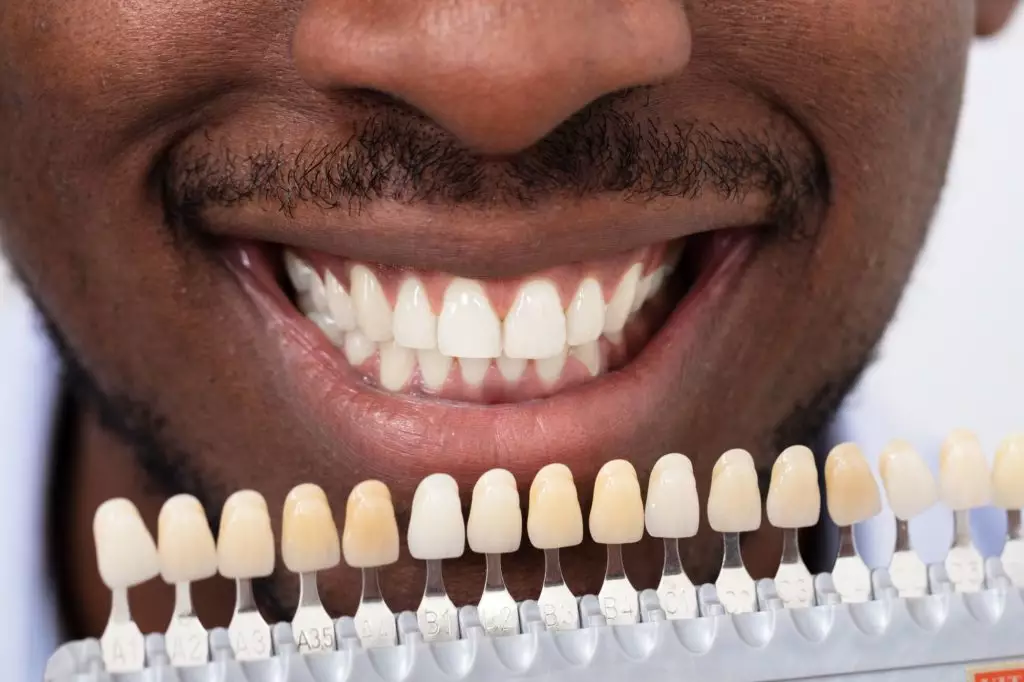 Dental veneer samples held in front of patient's teeth to determine desired shade