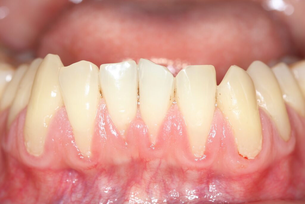 Primer plano de una recesión gingival en los dientes frontales inferiores de un paciente odontológico.