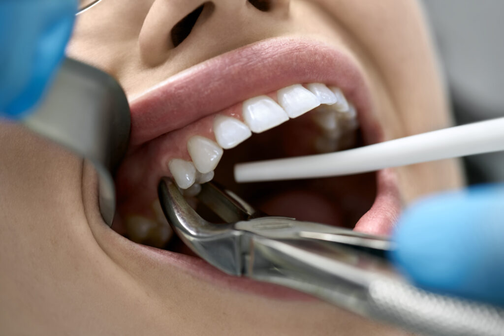 Primer plano de una extracción dental: un dentista con guantes de látex azules extrae un diente a una mujer con la ayuda de un retractor de mejillas y unas pinzas.