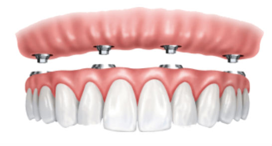 Hybrid dentures