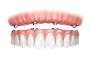 Hybrid denture supported by implants