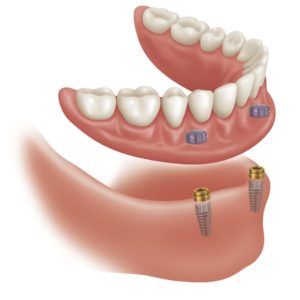 Denture supported by implants
