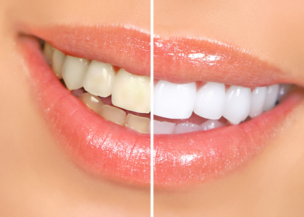 Teeth whitening before and after picture - closeup of woman's smile.