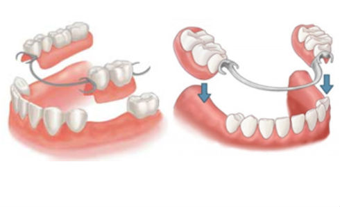 Illustration of partial dentures