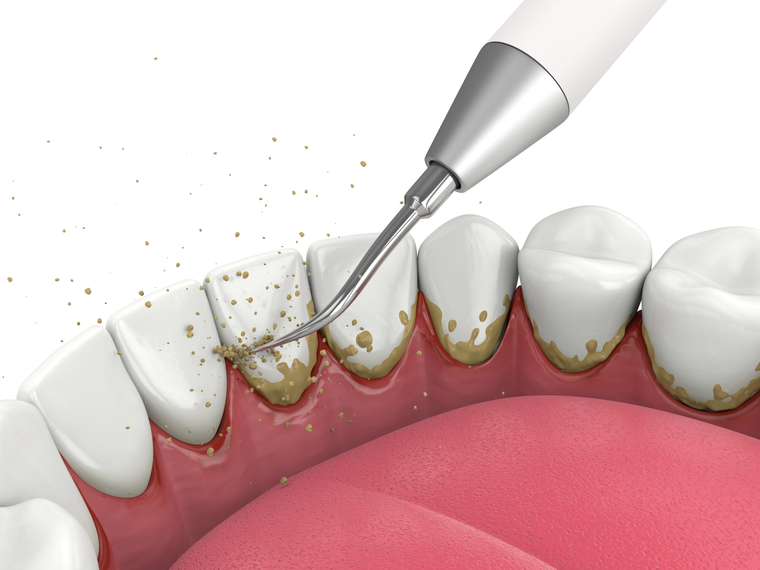 Reproducción de la eliminación de la placa de los dientes con un desincrustante ultrasónico.