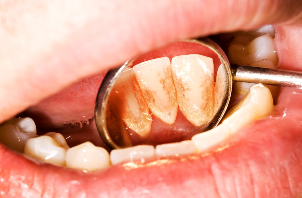 Imagen de dientes inferiores cubiertos de sarro dental