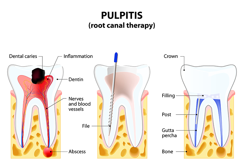 Diagram of abscessed tooth and root canal