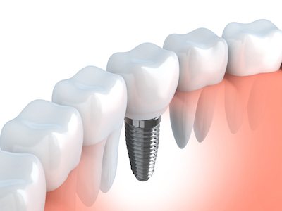 Single Tooth Implant