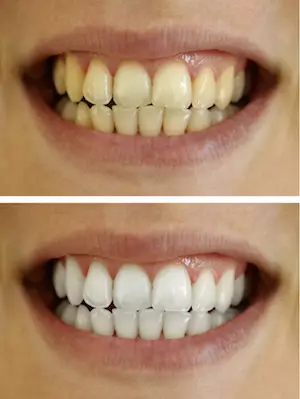 Teeth Whitening before and after image
