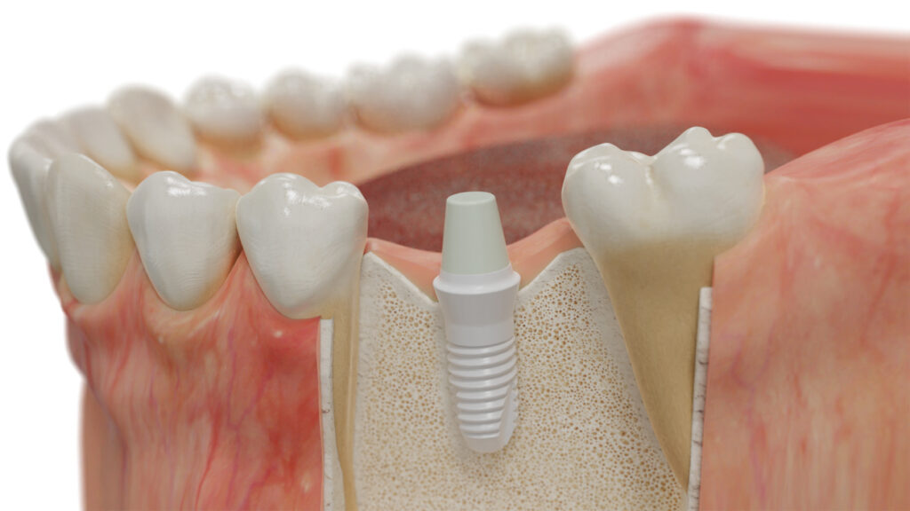 Dental model of a white, zirconia implant placed in a jawbone.