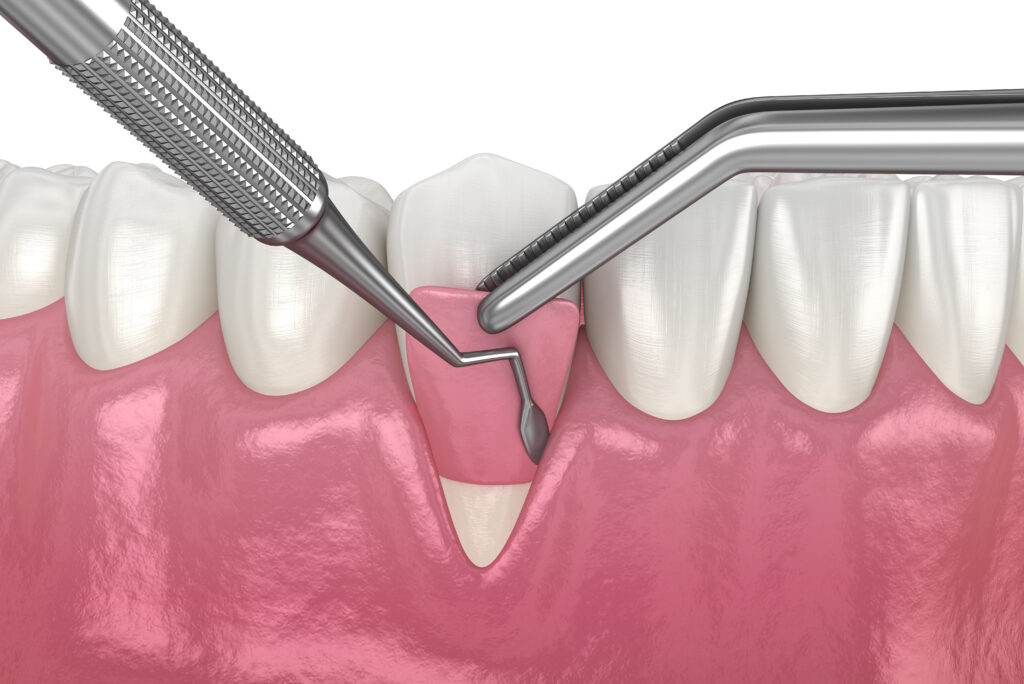 3D illustration of gum recession being covered up with a gum graft