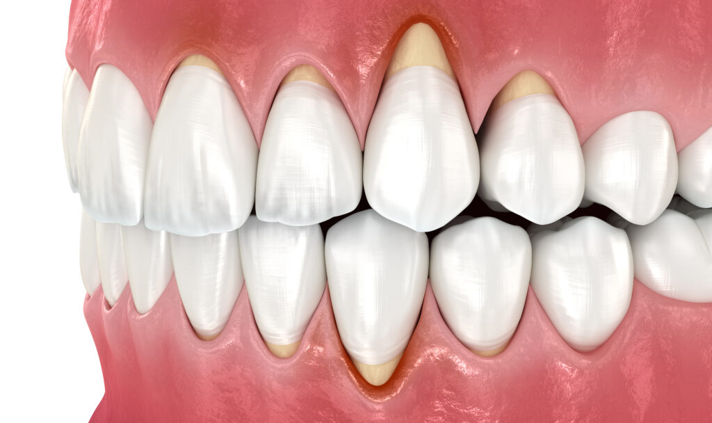 3D illustration of gingival (gum) recession. Gums are pulling back from several upper and lower teeth.