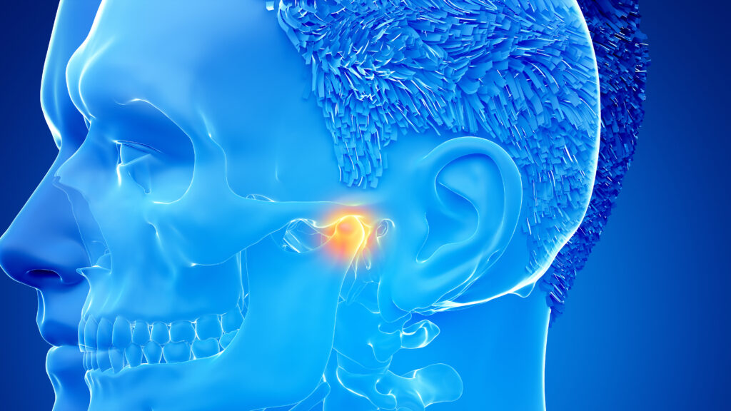 Ilustración renderizada en 3D de una articulación temporomandibular dolorosa
