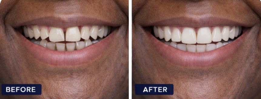 Carillas de porcelana