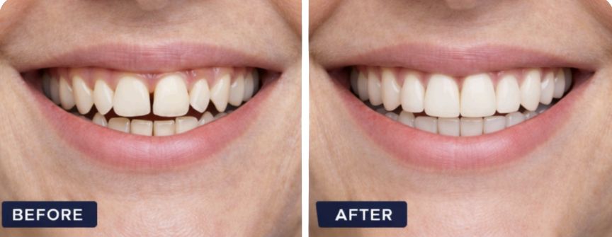 Carillas de porcelana