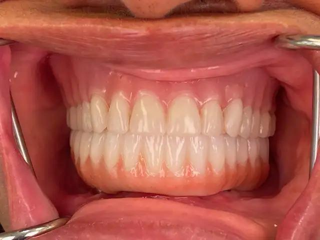 All-on-4 Dental Implants Wilmington - O2 Dental Group - O2 Dental Group All-on-4 Dental Implants Wilmington