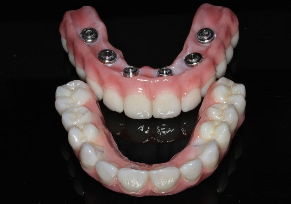 All-on-4 Full-Arch Implants Treatment - O2 Dental Group - O2 Dental Group All-on-4 Full-Arch Implants Treatment
