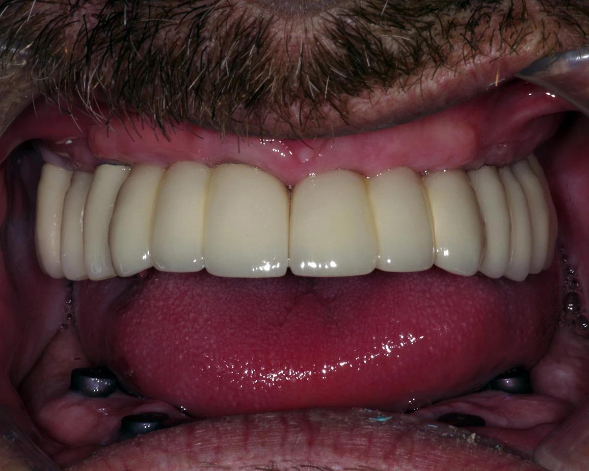All-on-4 Implants - O2 Dental Group - O2 Dental Group All-on-4 Implants