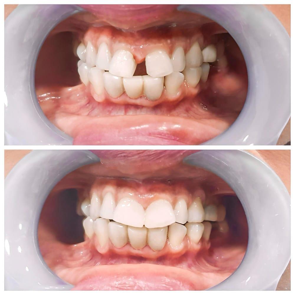 Composite Bonding - O2 Dental Group - O2 Dental Group Composite Bonding