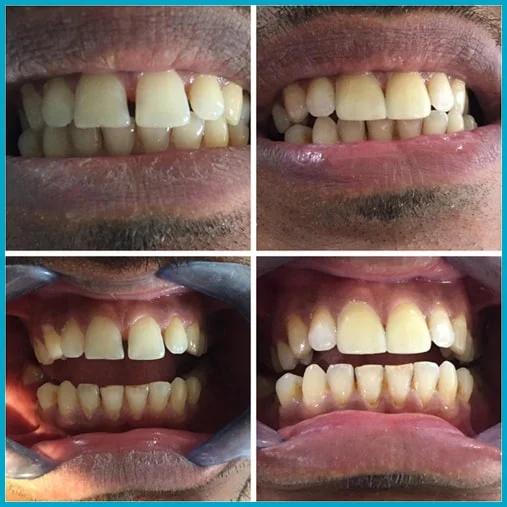 Composite Dental Bonding - O2 Dental Group - O2 Dental Group Composite Dental Bonding