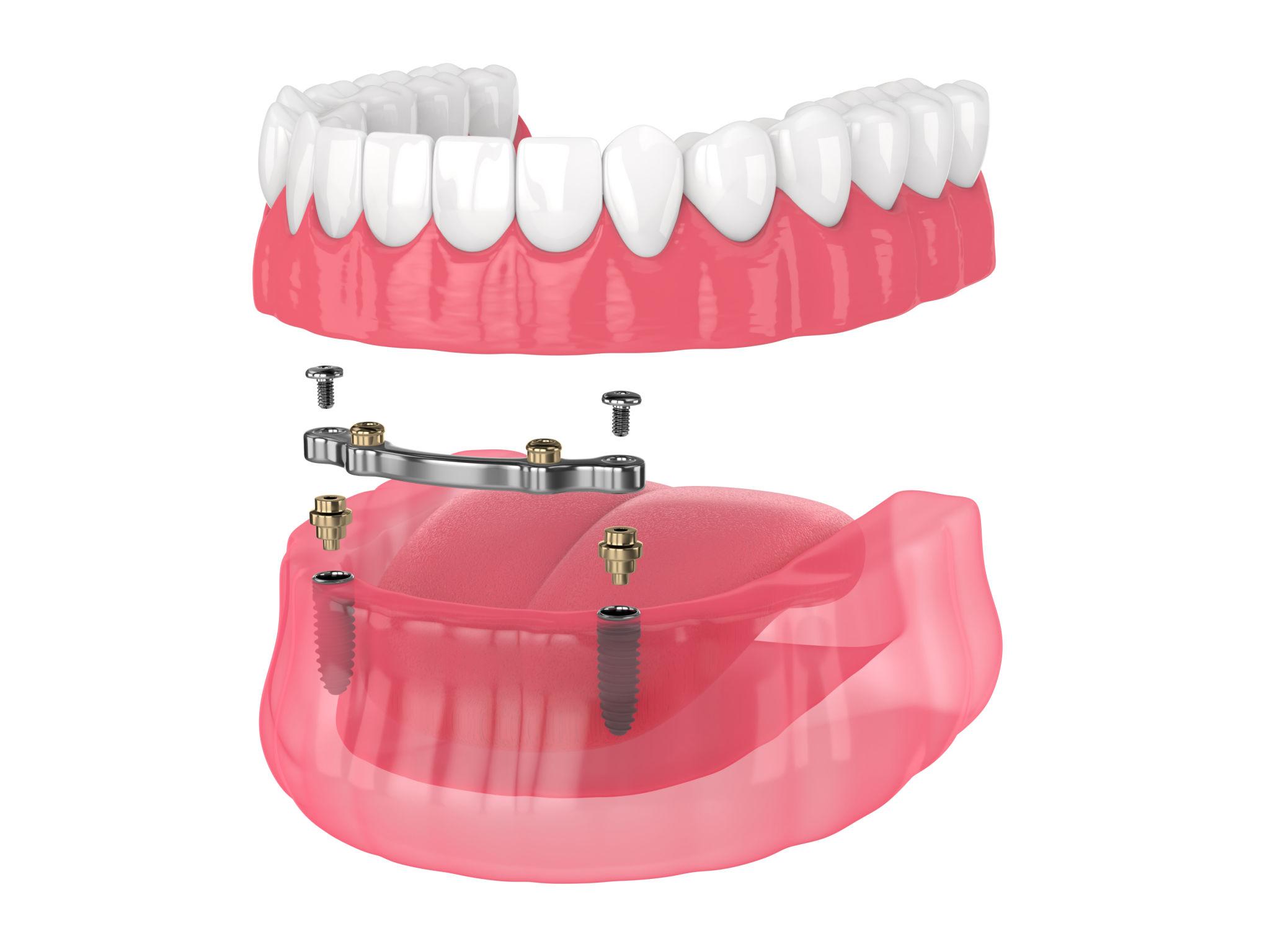 3D illustration of dental implants with abutments attached beneath pink gum tissue in the upper jaw.