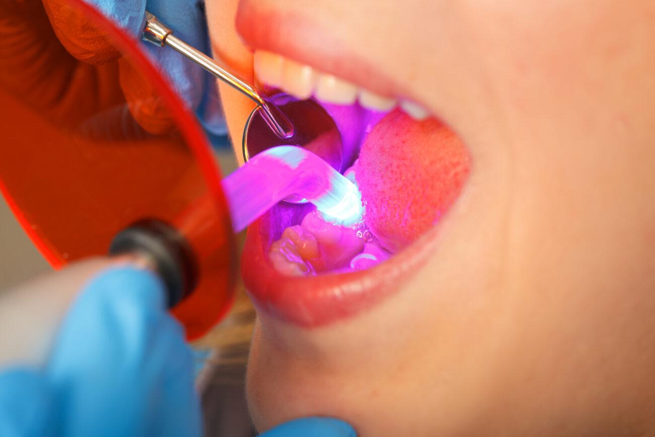 Dental Bonding Consultation Southern Pines NC​