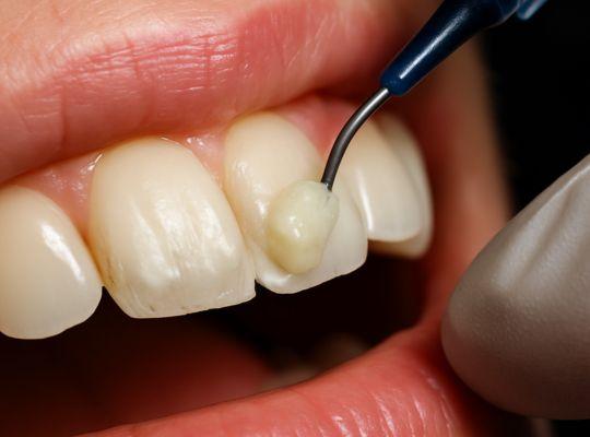 Dental Bonding Consulting Siler City