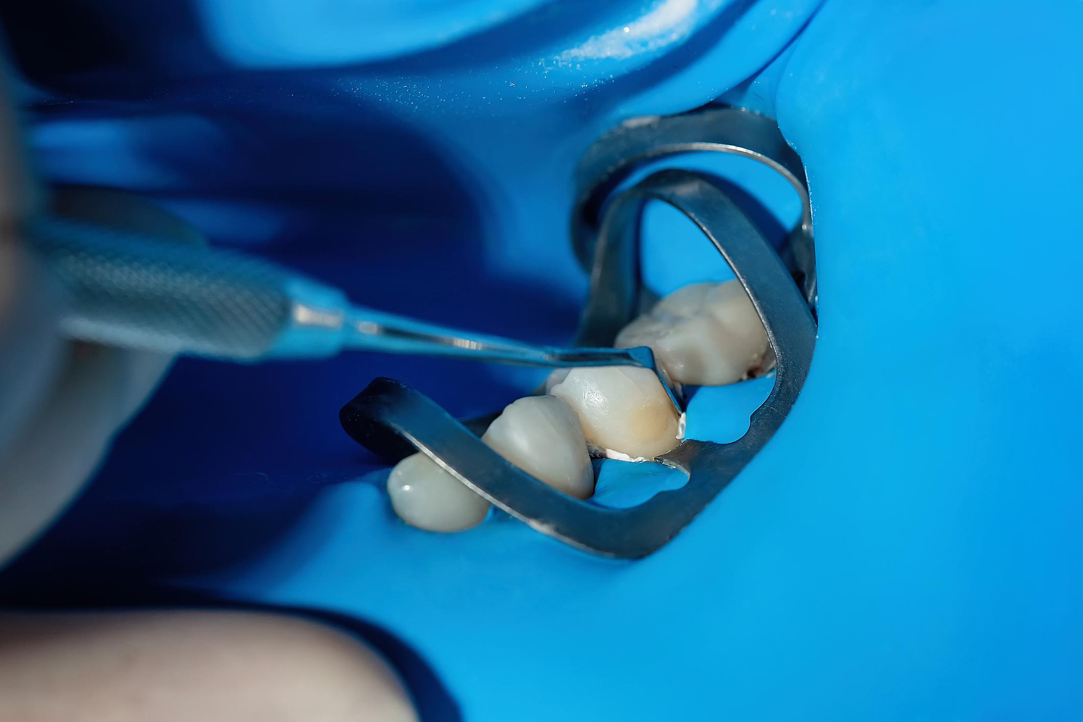 Dental Bonding Dentist in Fayetteville