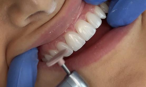 Dental Bonding Durham NC