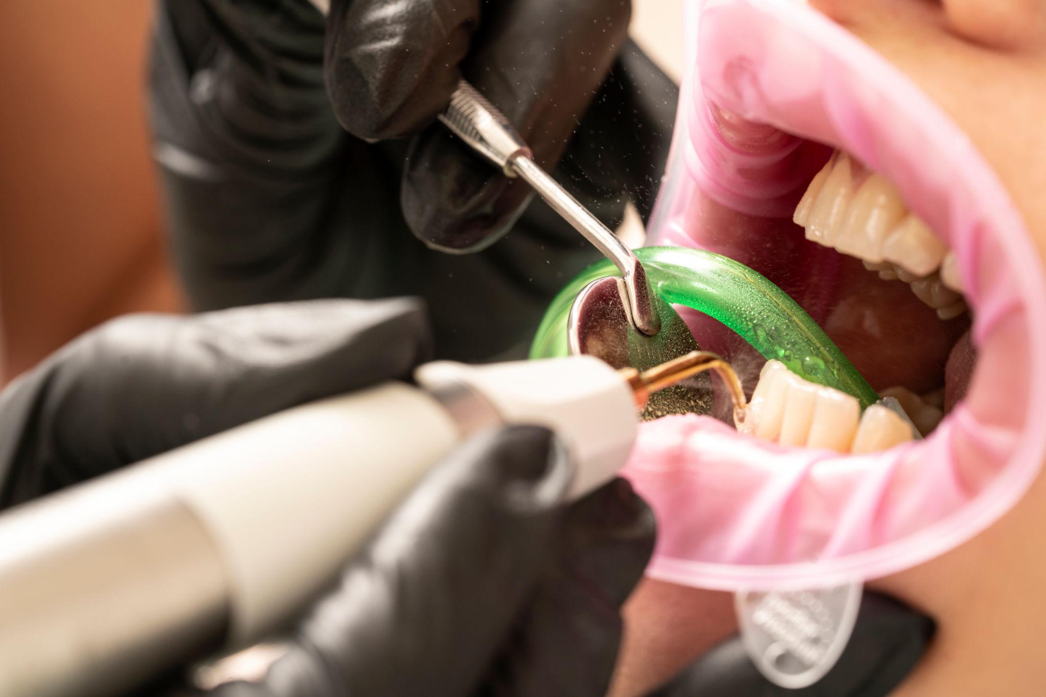 Dental Bonding North Carolina