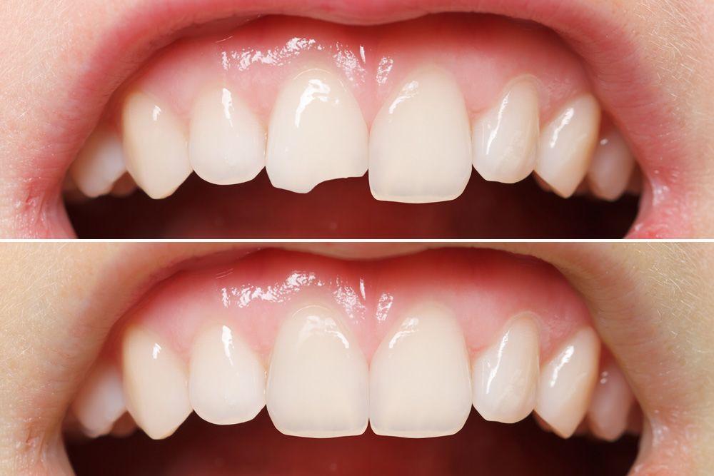 Dental Bonding Southern Pines NC​