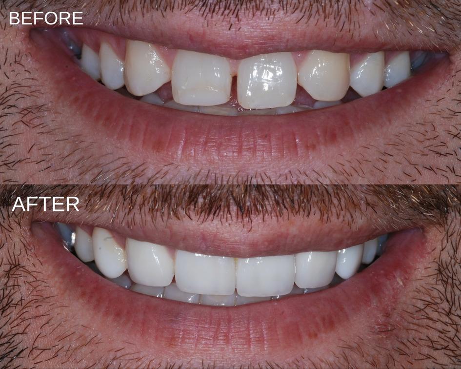 Dental Bonding Southern Pines