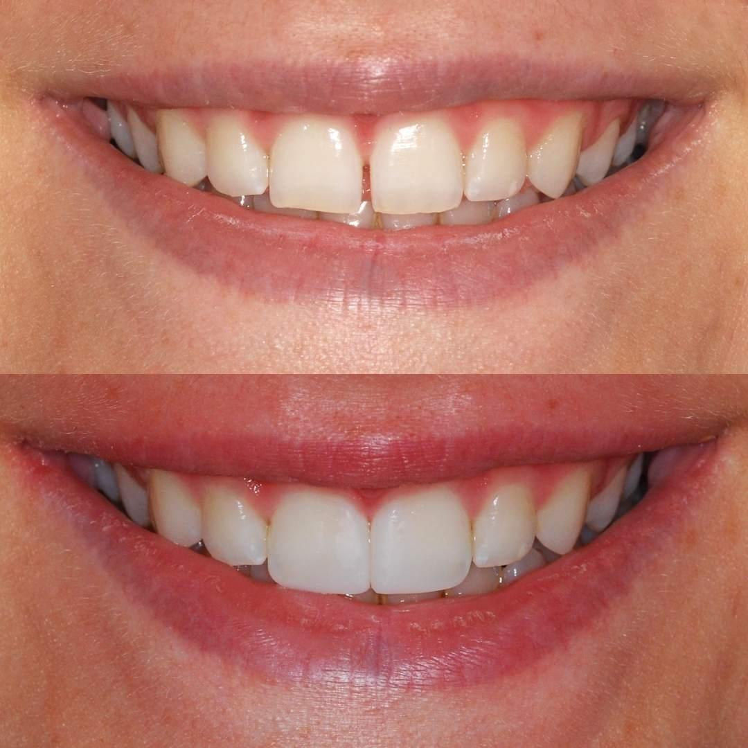 Dental Bonding Treatment Raleigh NC