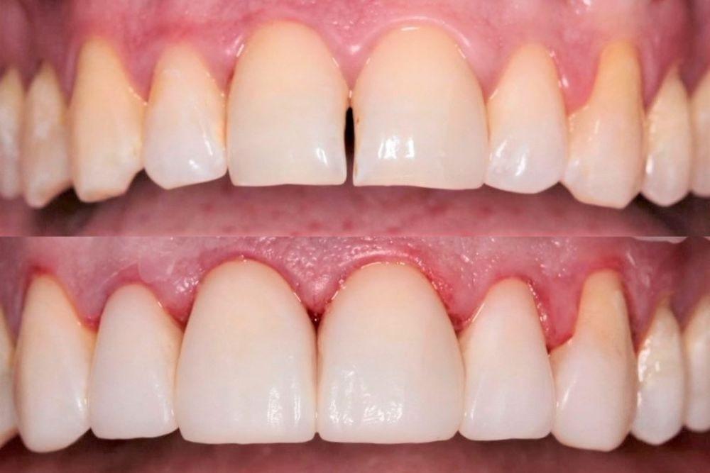 Dental Bonding Treatment Southern Pines NC​
