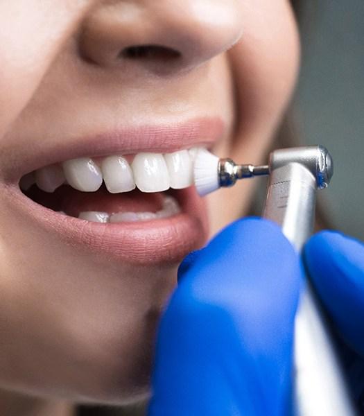 Dental Bonding Treatment in Durham NC